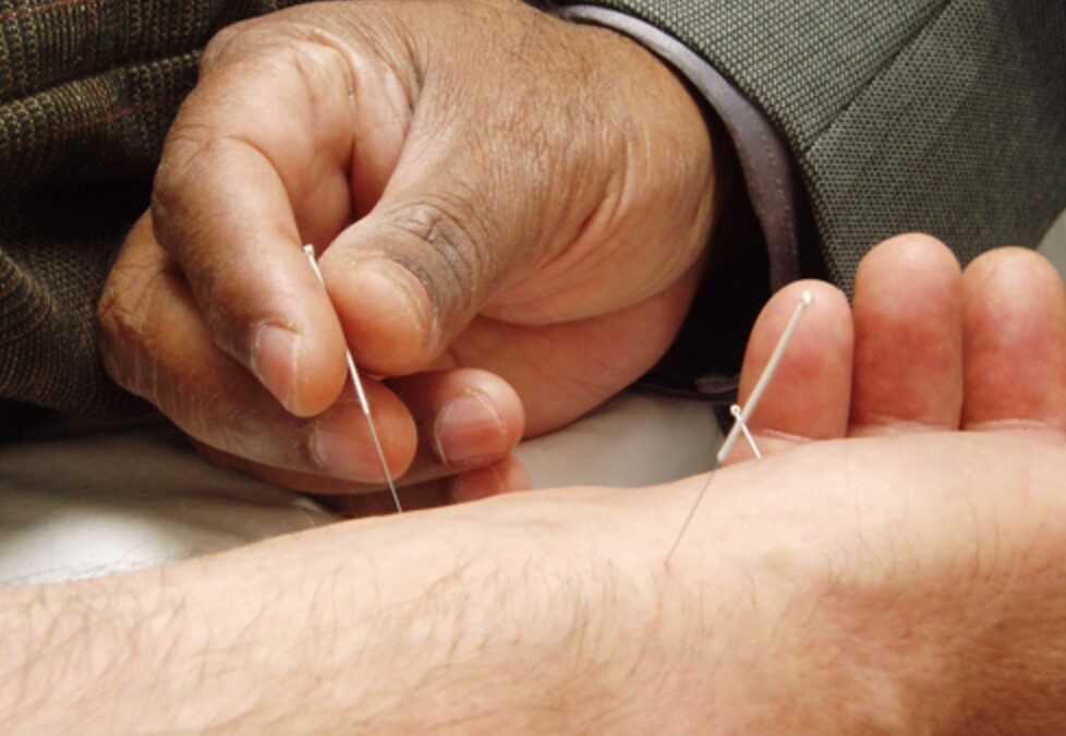 Acupuncture