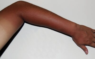 Sunburn, Suncreen, or Artificial Tan: Which is Best?